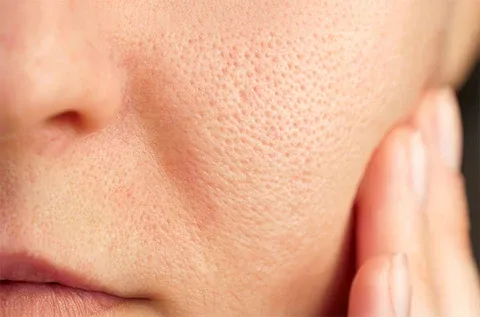 Pores