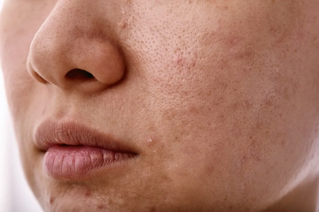 Textured skin