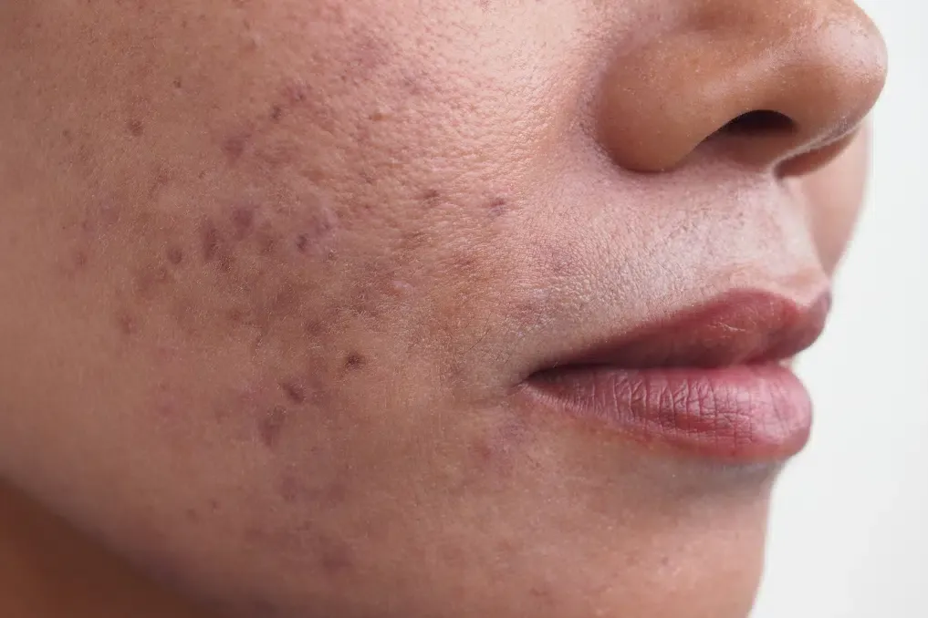Hyperpigmentation