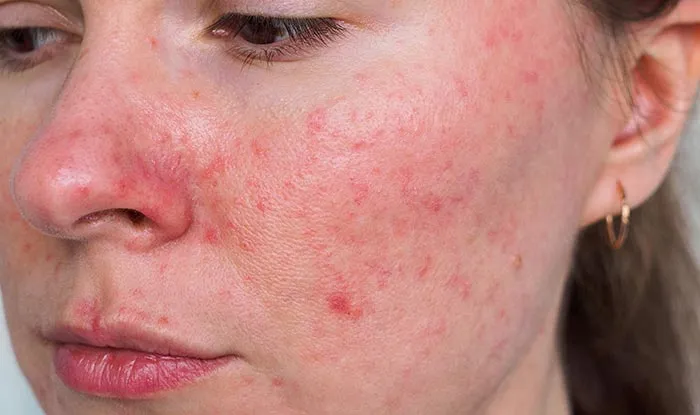 Rosacea / Redness
