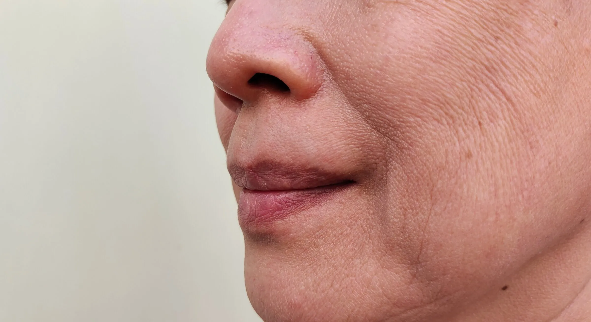 Wrinkles