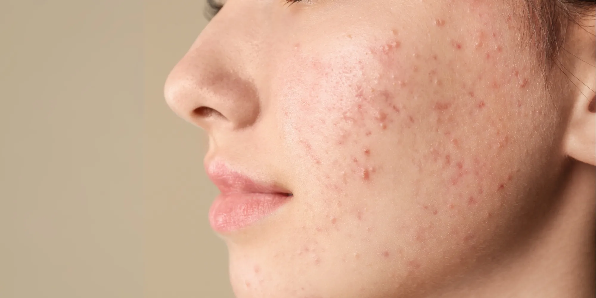 Damaged Skin Barrier