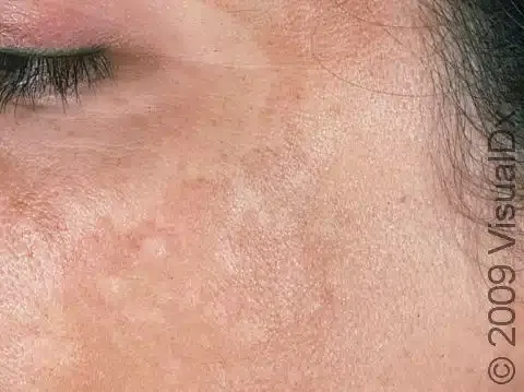 Melasma / Mesta