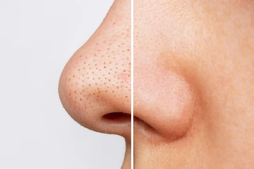 Blackheads & Sebum