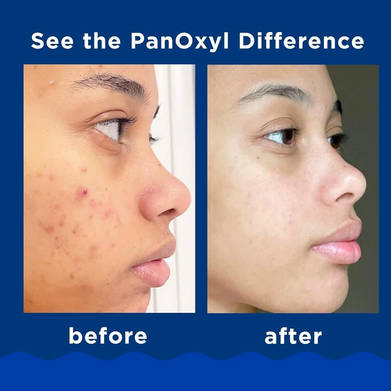 PanOxyl Acne Foaming Wash 10% Benzoyl Peroxide (face & body) 156gm - Image 4