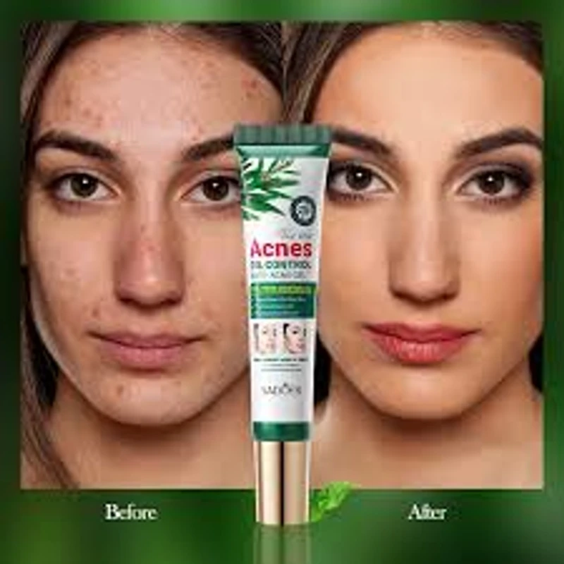 Anti-Acnes Gel - Image 3